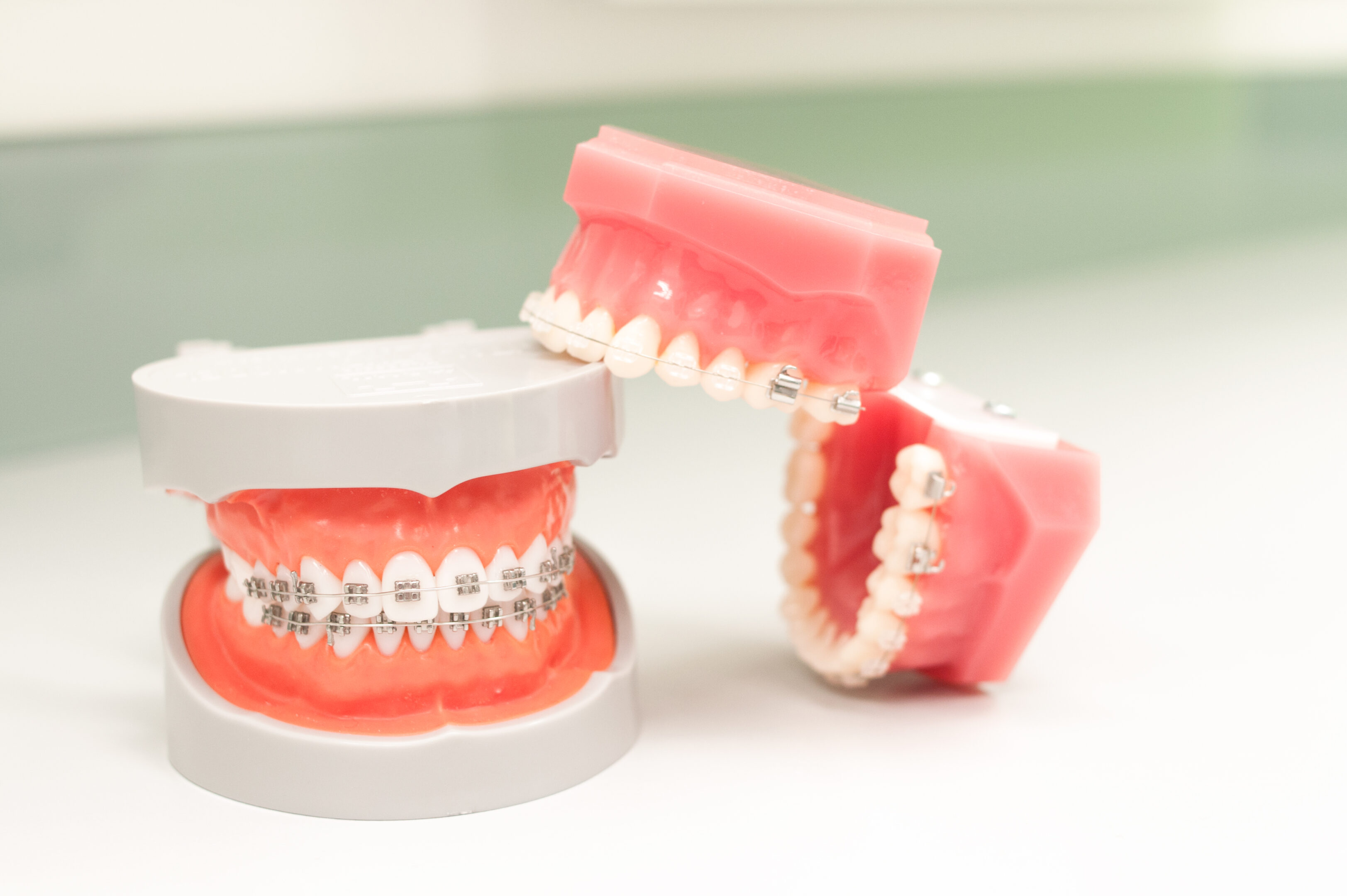 dentalclinic-dallatorre-festsitzende-zahnspangen-1767